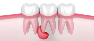 Лечение кисты зуба: современные методы и эффективные подходы